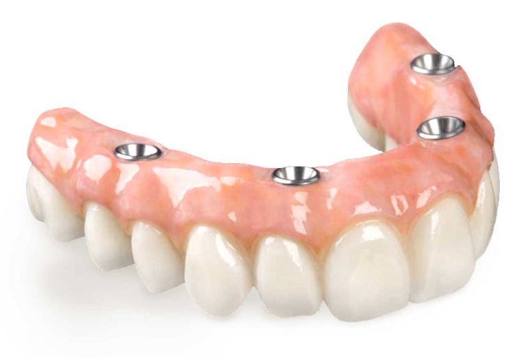 Implant Retained Dentures Ballarat Denture Clinic 